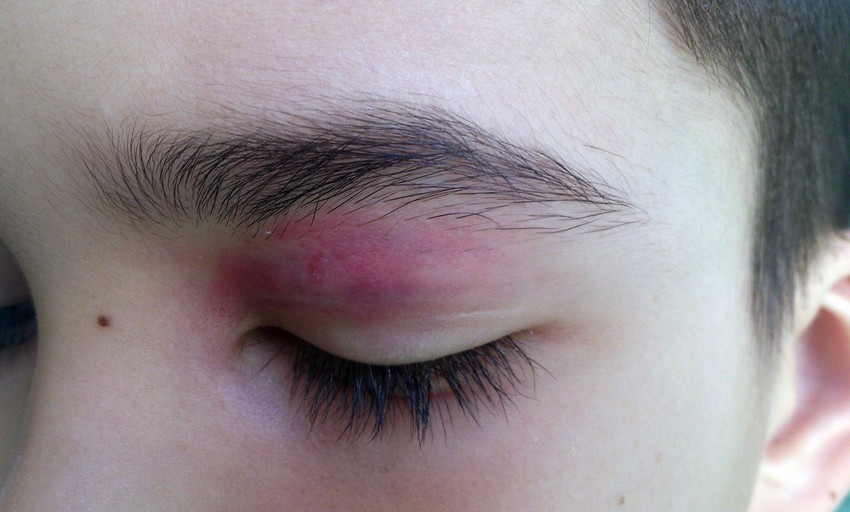 Ničim izazvan napad na vršnjaka: Hematom na očnom kapku