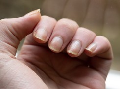 Na co chorują paznokcie? OBJAWY, których nie można bagatelizować