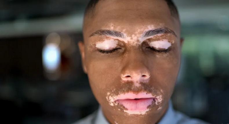 Man with vitiligo