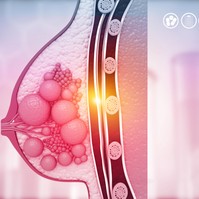 Jóindulatú emlődaganatok tünetei, vizsgálata és kezelési lehetőségei