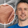 Celulit je kompleksan problem koji zahteva sistemski pristup