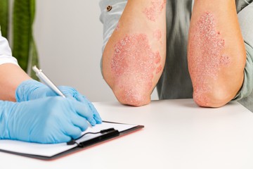 pszoriázis, pikkelysömör, artritis, ízületi gyulladás, cukorbetegség, bőrbetegség