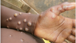 Nigeria, Canada partner to address Mpox