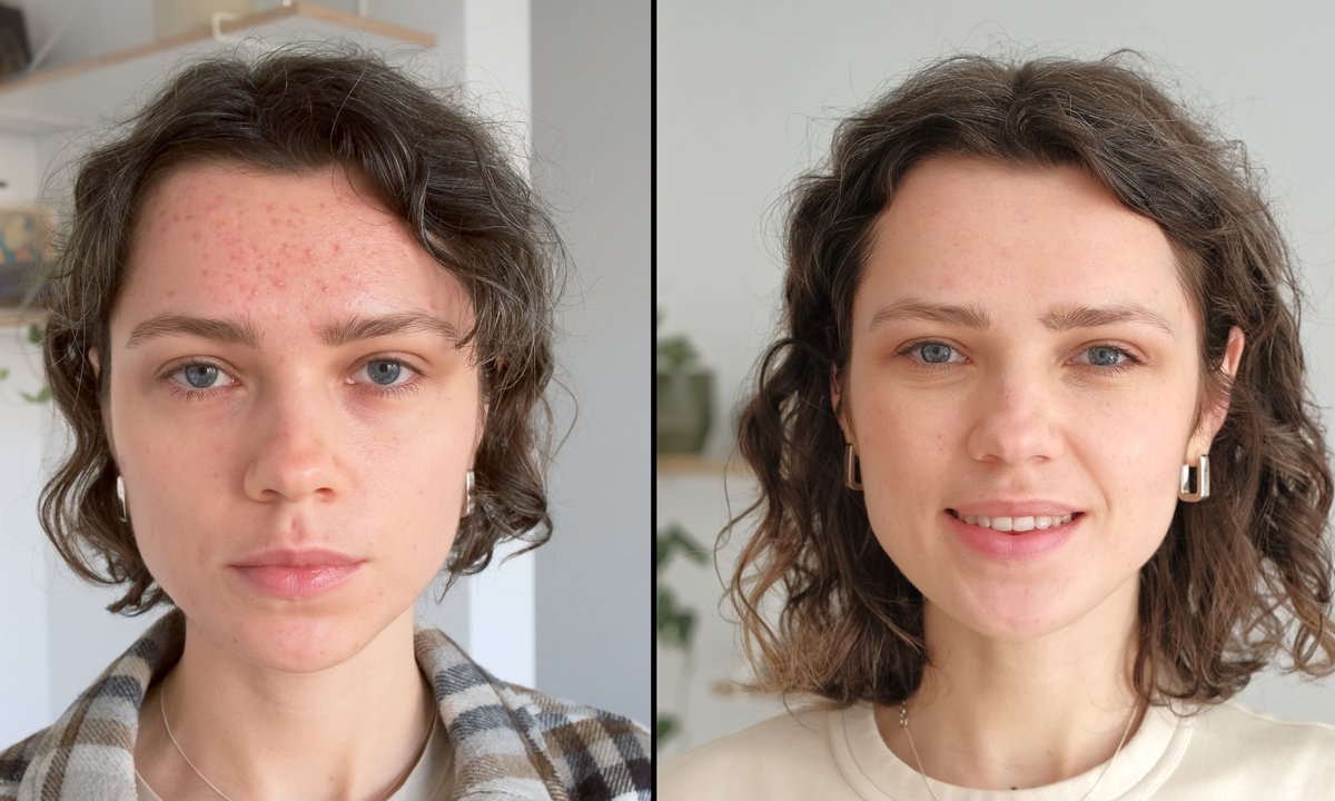 To serum rozjaśnia przebarwienia jak laser. Ślady po trądziku nie mają szans