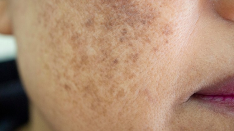 melazma, bőrfolt, foltok a bőrön, melanin, fényvédelem