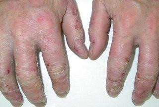 Wyprysk rąk - Choroby skóry