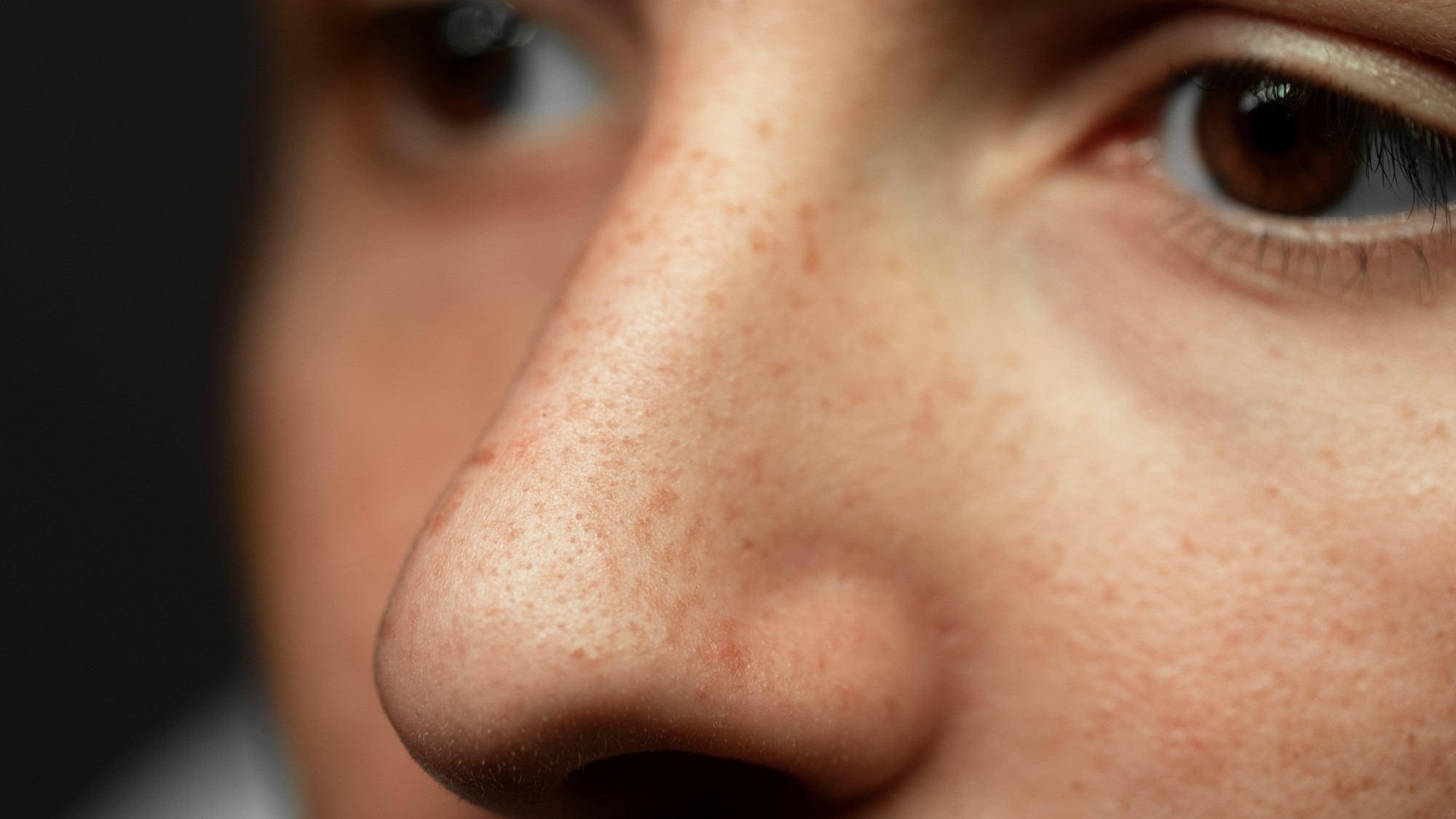 Tmavé škvrny spôsobené hyperpigmentáciou pokožky.