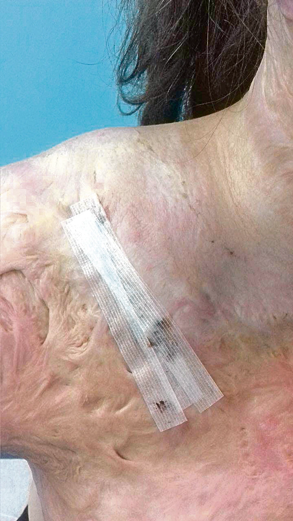 Na poslednjoj operaciji koju je imala pre desetak dana Vasili su stavili silikonski balon pod kožu. Kada otpadnu konci, puniće ga vodom da bi dobili višak zdrave kože koji će posle lekari da presade na njen vrat