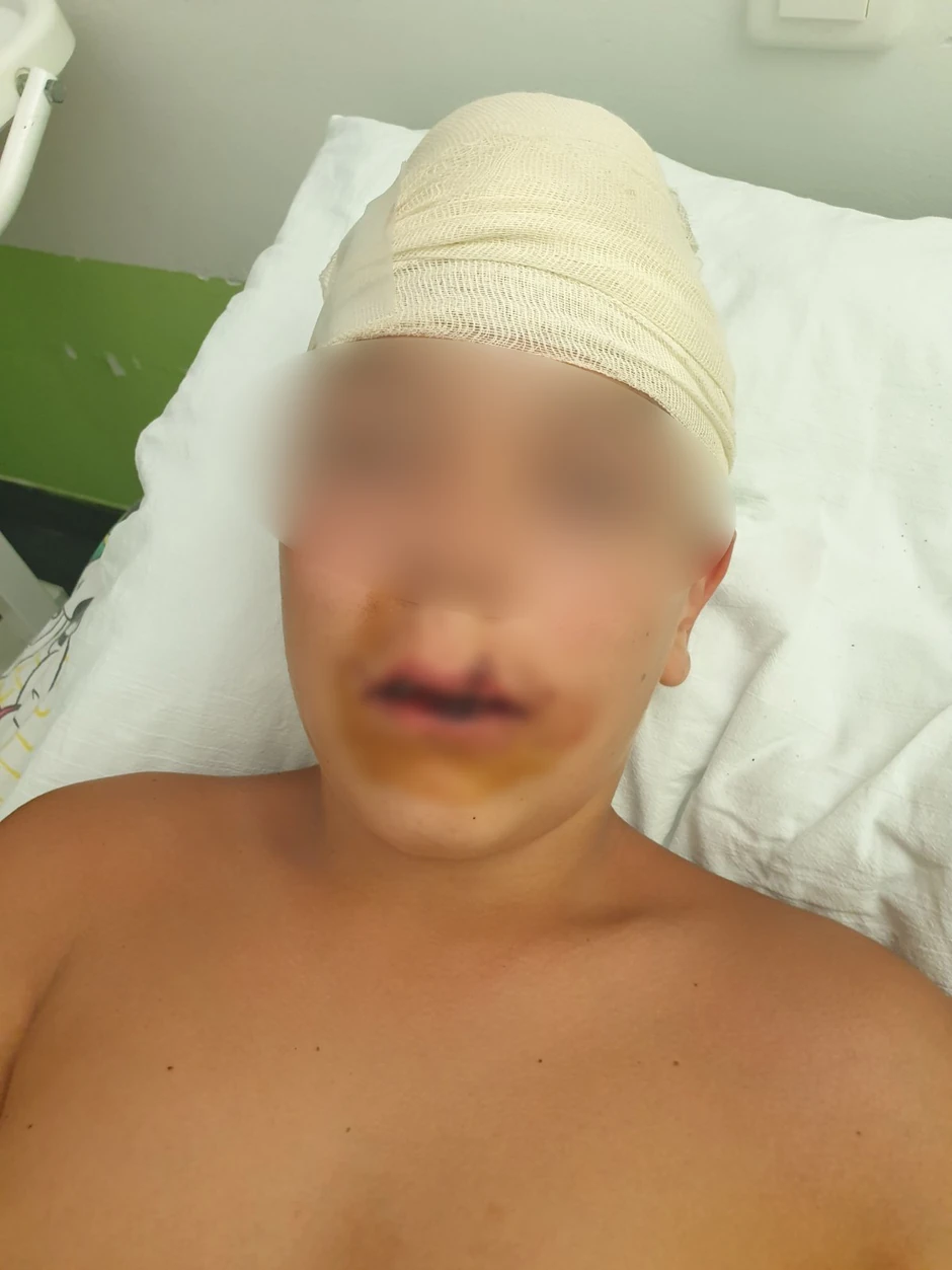 Povređeni dečak B.P. nakon saniranja povreda