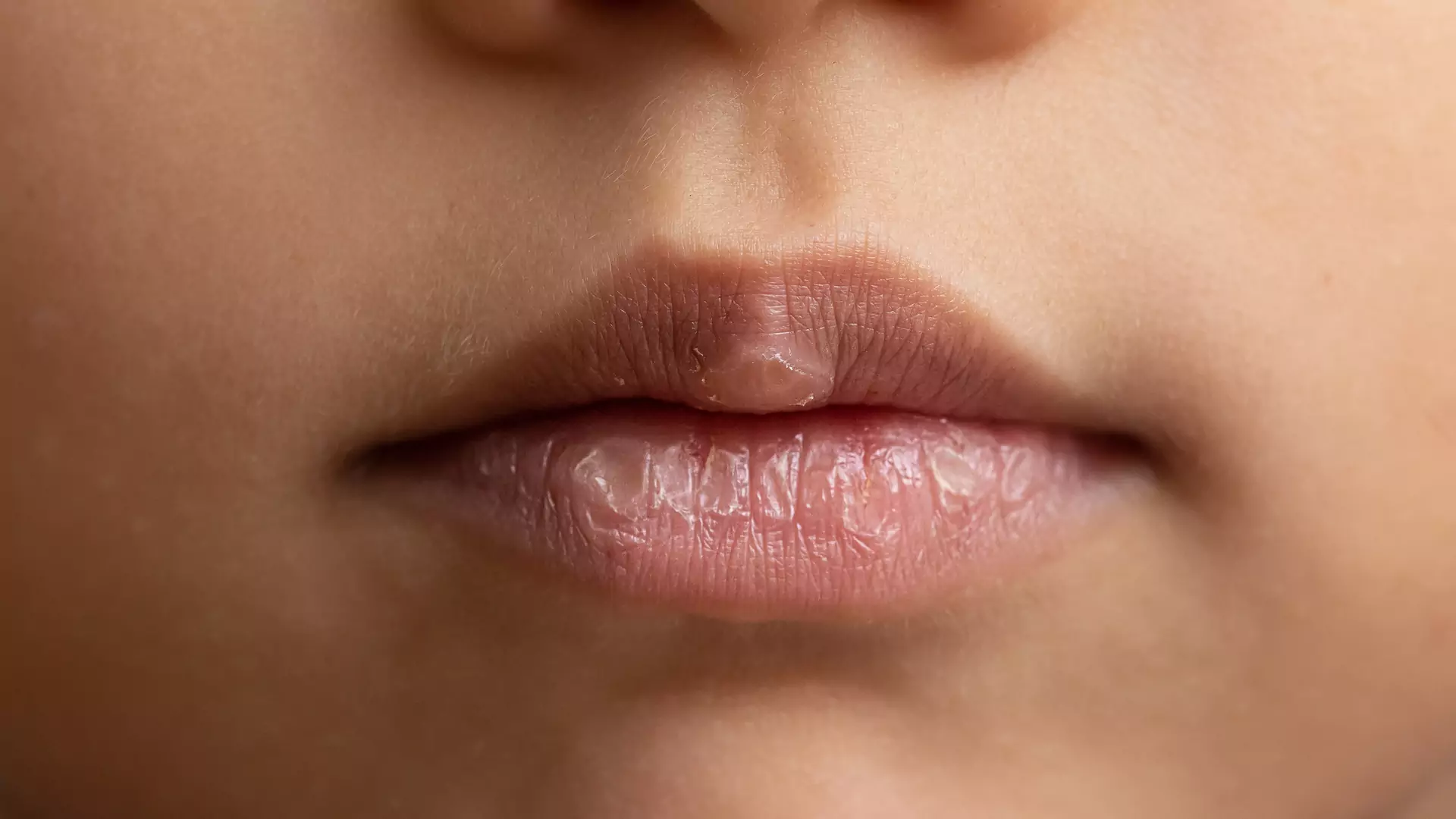 Spierzchnięte usta mogą świadczyć o chorobie. Zwróć uwagę na te sygnały