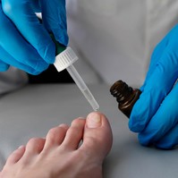 Körömgomba ellen ezt a tanácsot fogadja meg a bőrgyógyásztól!