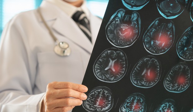 Lakunarni moždani udar  je po život opasno medicinsko stanje 