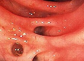 diverticulosis-d000012468b5c73ad2179