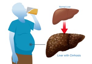 Vikend opijanje je štetnije za jetru nego isti broj pića raspoređen tokom nedelje