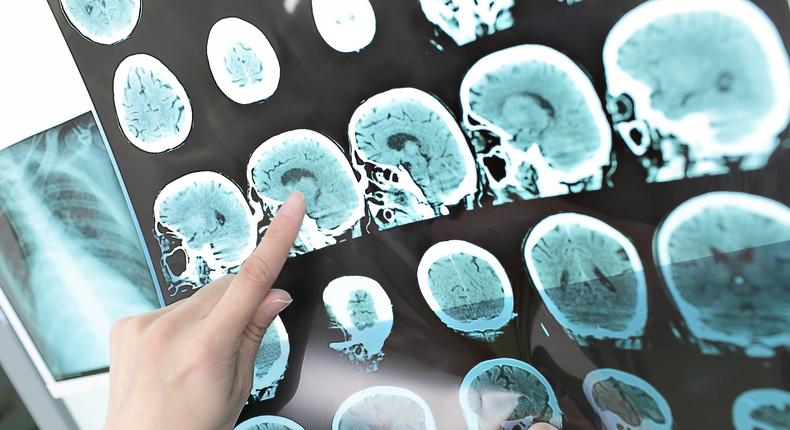 A doctor uses a CT scan of a patient's brain to look for signs of a stroke or blood clots.