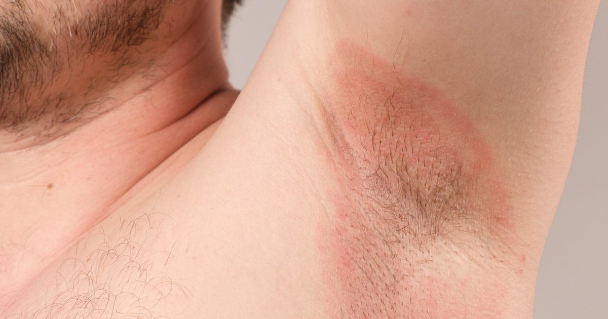 6 causes of underarm rashes and how to avoid irritating your armpits ...