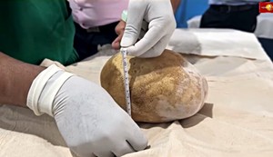 Lekari uspešno su uklonili kamen iz bešike težak 3,1 kg, što je najteži poznati slučaj u medicinskoj istoriji