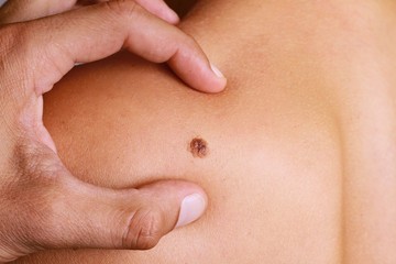 melanóma, bőrrák, daganat, tumor