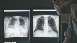 Co się dzieje w płucach po COVID-19?