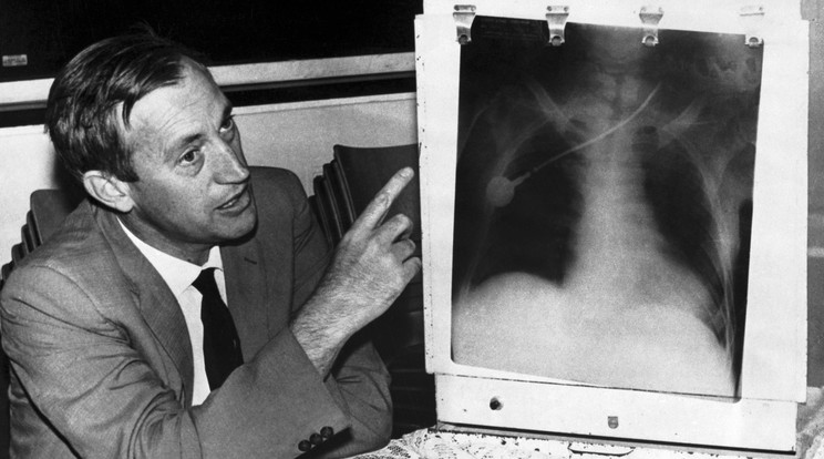 Christian Barnard sebész egy röntgenfelvételt mutat Louis Washansky mellkasáról, amelyet az első szívátültetés során készítettek. / Fotó: Getty Images