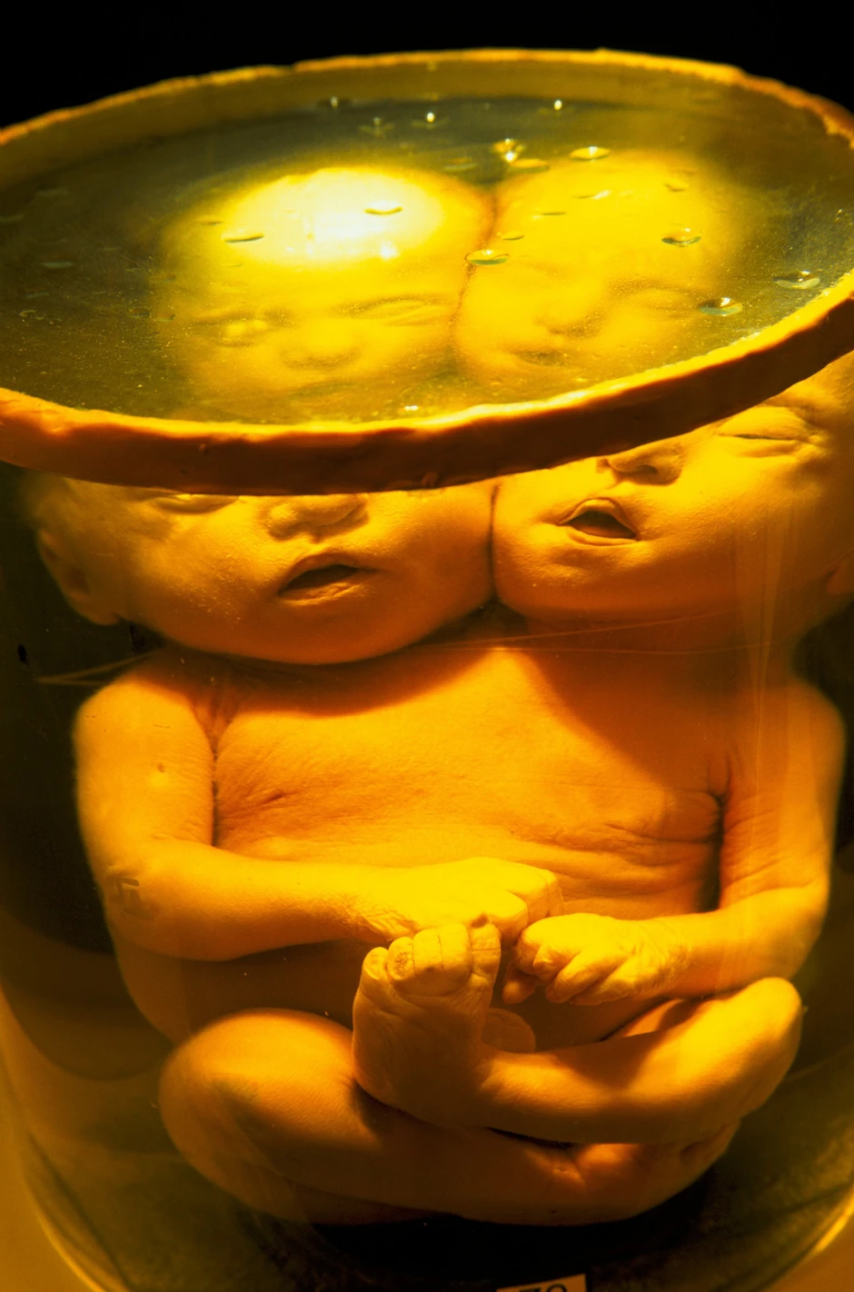 Konačan broj smrtnih slučajeva se i dalje ne zna, s obzirom na to da je rak koji je povezan sa zračenjem klinički teško razlikovati od "običnog raka"