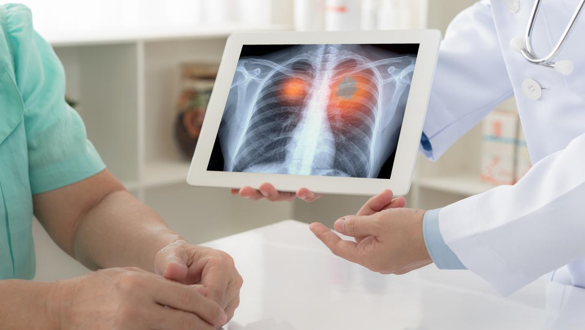 W Polsce wciąż nie wszyscy chorzy na raka płuca mogą liczyć na właściwe leczenie