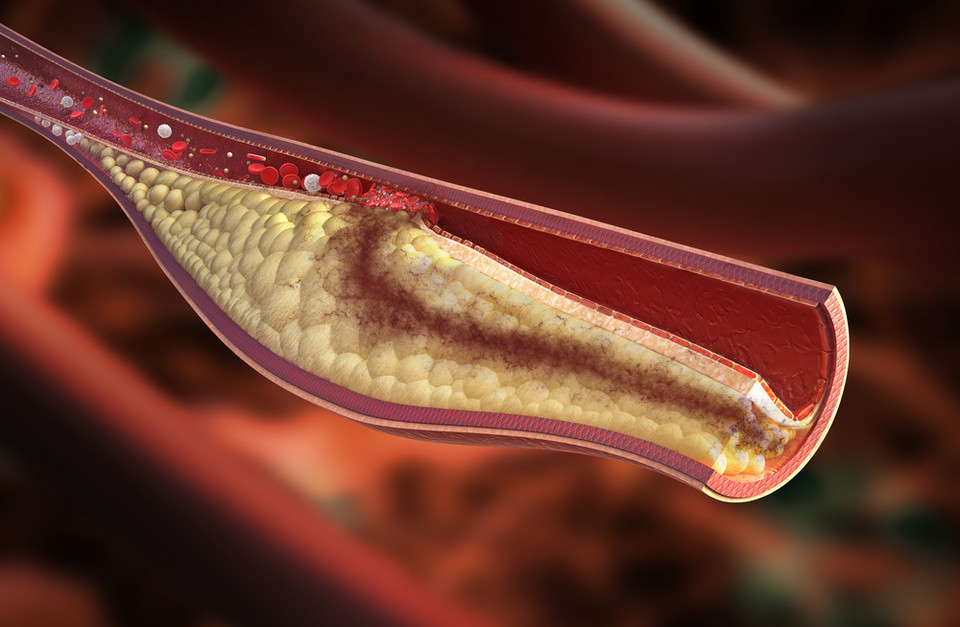 4. Wysoki poziom cholesterolu LDL