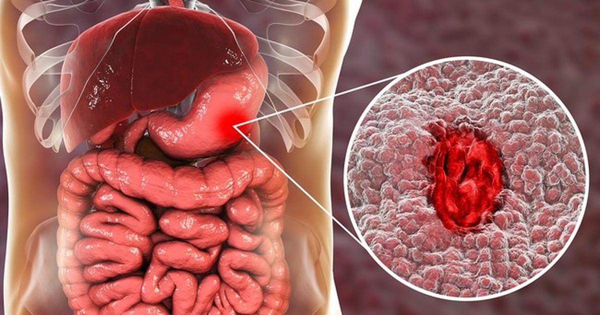 Get To Know The 9 Glaring Stomach Ulcer Symptoms You Can U2019t