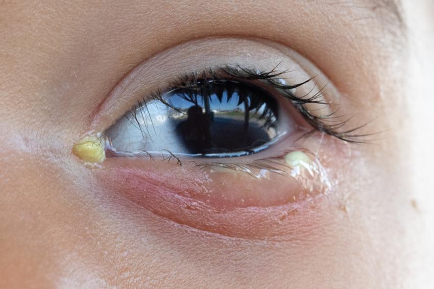 Kötőhártya-gyulladás: nem mindegy, mivel borogatja, ha ilyen a szeme! |  EgészségKalauz