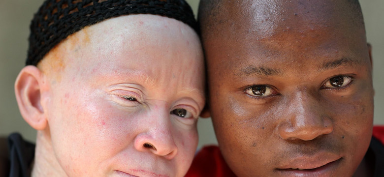 Rzeź albinosów w Malawi. "Mordercy wierzą, że ich kości zawierają złoto"
