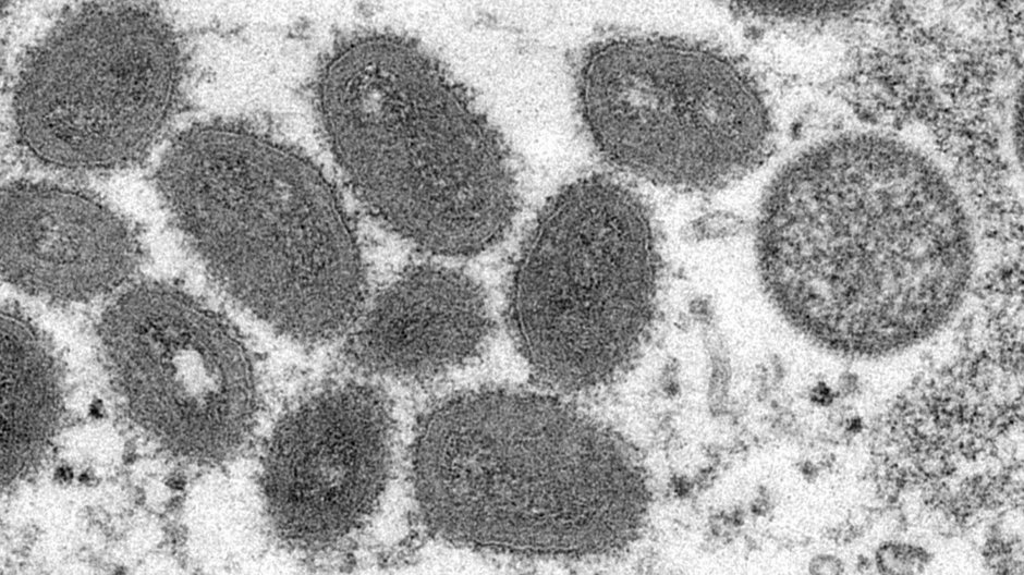 Wirus małpiej ospy pod mikroskopem