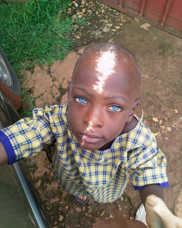 This abandoned little boy becomes internet sensation due to his unique birth mark 