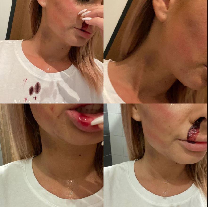 Nia megmutatta, hogy az orra vérzett, a szája felrepedt, a nyakán zöld foltok éktelenkedtek, miután megverte egy brutális férfi /Fotó: Instagram