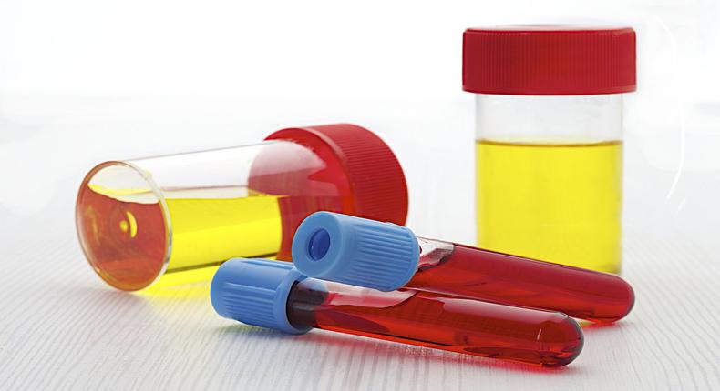 Causes of blood in urine(healthhearty)