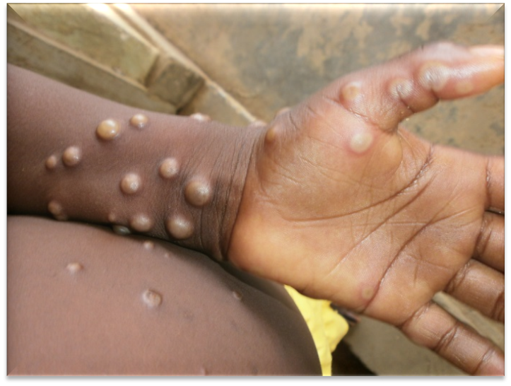 Monkeypox is a rare disease caused by monkeypox virus [WHO]