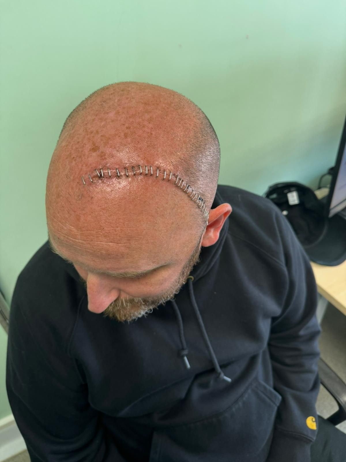 Lekárom sa nepodarilo odstrániť celý nádor.