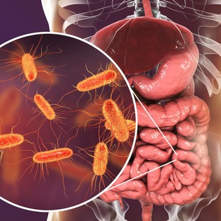 Tüdőrák: a bél mikrobiom felelős a daganat kialakulásáért?