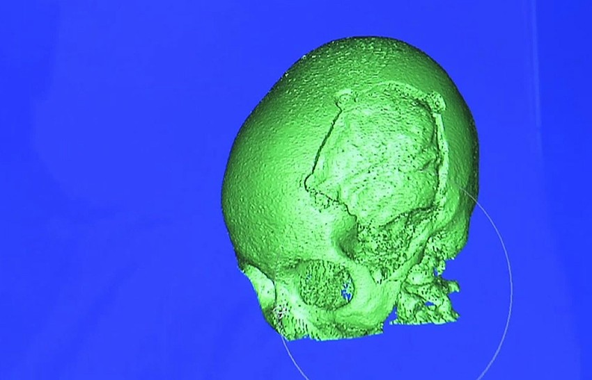 Mesto na lobanji na kojem će biti pričvršećena ploča