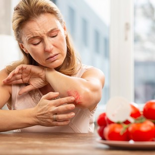 Ételallergia és allergiás kiütések: ezt üzeni a bőr az immunrendszerünkről