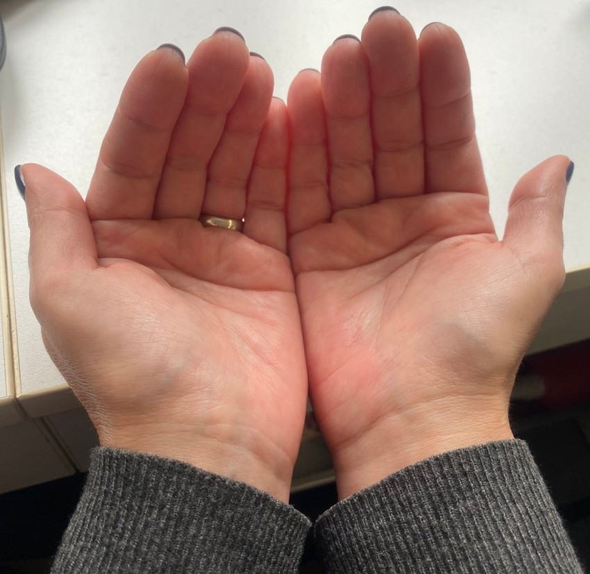 Palmarna eritema ponekad nema poznati uzrok