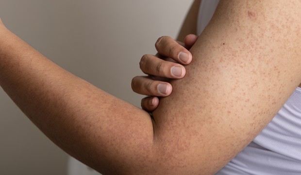 Keratoza pilaris, poznata kao "guščja koža", izaziva hrapave, crvene ili bele kvržice na koži