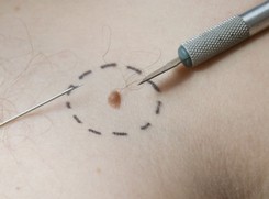 Czerniaka wykrytego wcześnie można wyleczy. Raz w miesiącu trzeba oglądać skórę