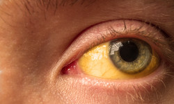 Czy żółte oczy to objaw choroby?
