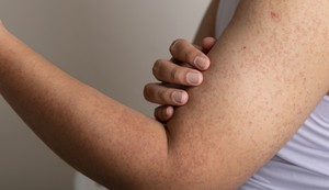 Keratoza pilaris, poznata kao "guščja koža", izaziva hrapave, crvene ili bele kvržice na koži