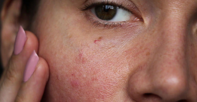 Pięć błędów, które pogarszają stan skóry wrażliwej i skłonnej do alergii 