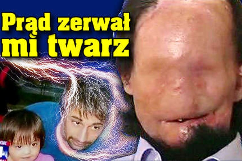 Prąd zerwał mi twarz