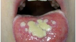 Afta na języku - przyczyny i leczenie afty w jamie ustnej. Jak zapobiegać aftom?