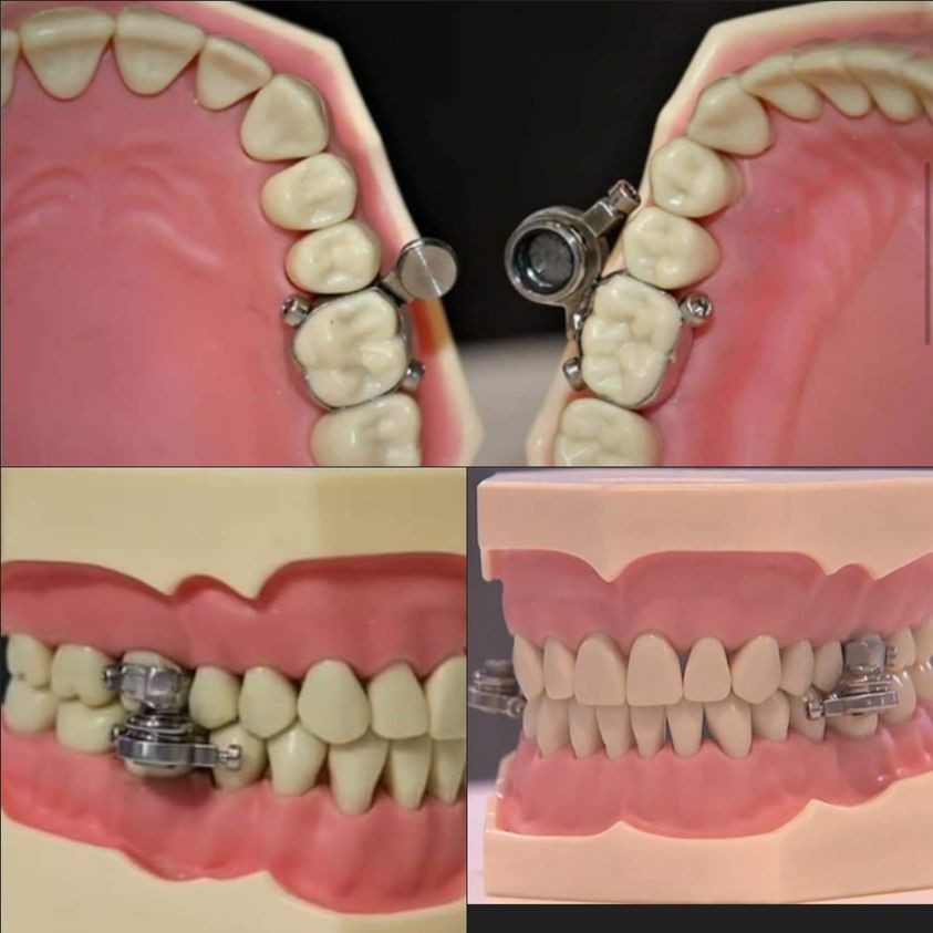 Weight loss device that locks your teeth to stop you from chewing until you become slim