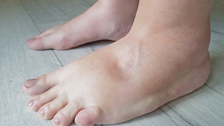 Ödéma oka jele, szívbetegség tünete