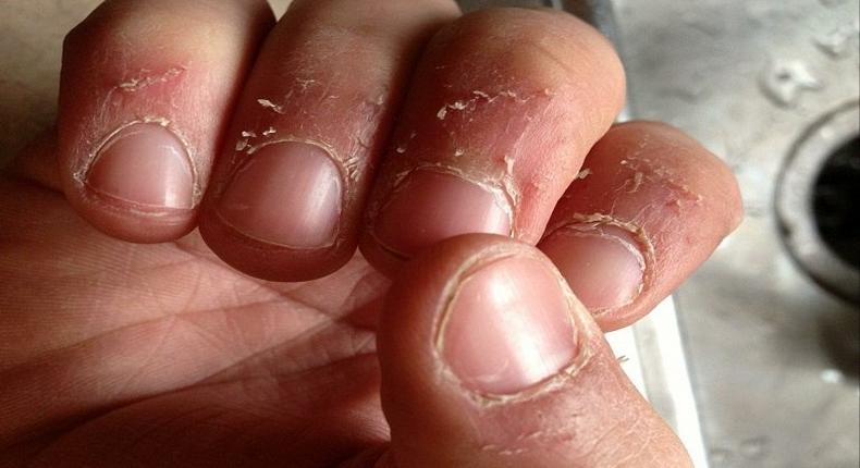 Damaged fingernails